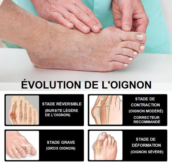 Chaussettes Orthopédiques Anti-oignons