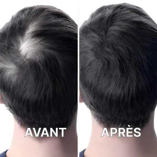 Casque Pour La Repousse Des Cheveux
