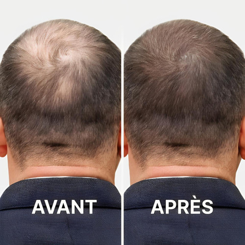 Casque Pour La Repousse Des Cheveux