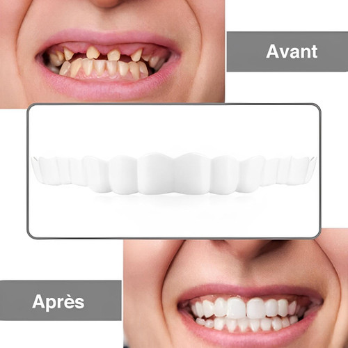 Facettes Dentaires à Clipser