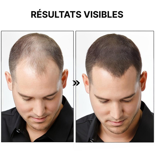 Spray Contre La Perte De Cheveux HealthCare™