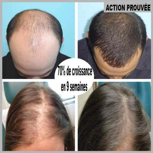 Sérum de repousse des cheveux en Roll-on