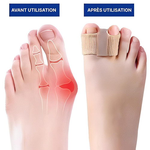 Séparateur d'Orteils Correcteur Hallux Valgus (lot de 2)